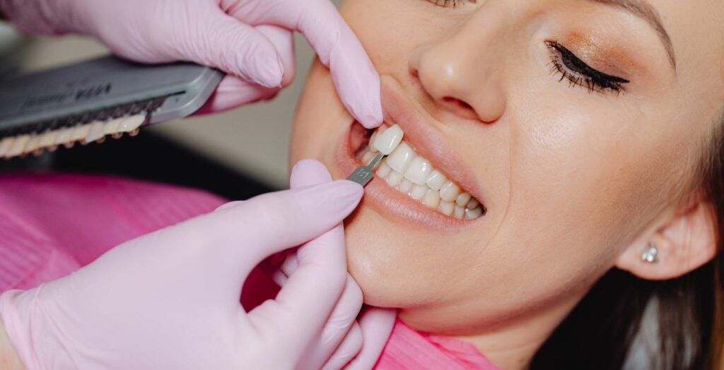 Dental Composite Veneers