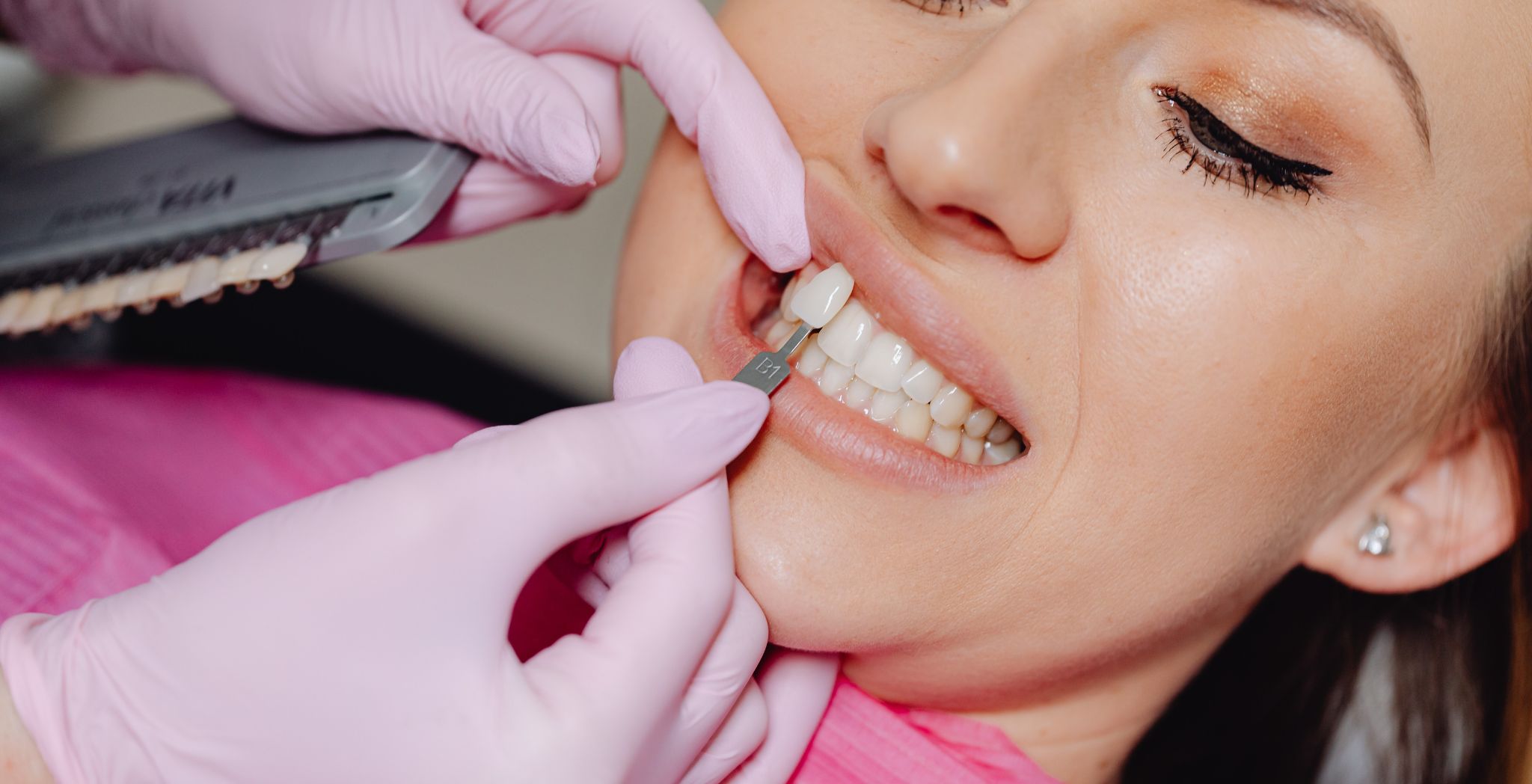 Dental Composite Veneers