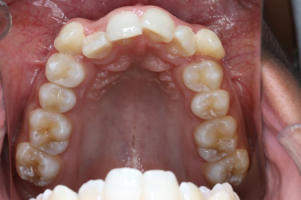 Upper dental arch showing teeth and gums