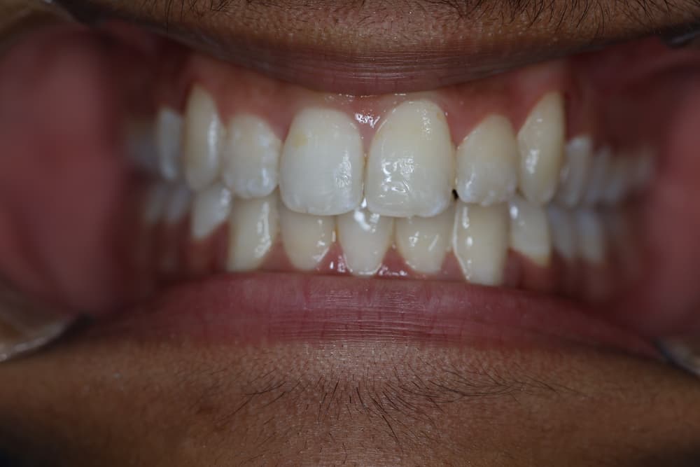 Close-up view of white teeth and pink gums