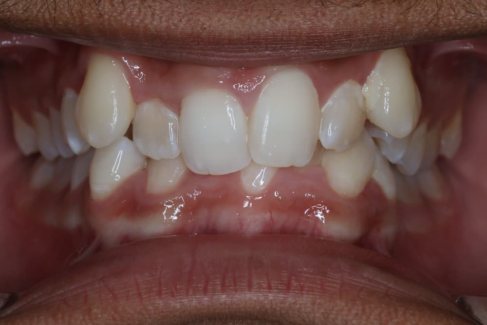 Close-up view of misaligned teeth and dental crowding