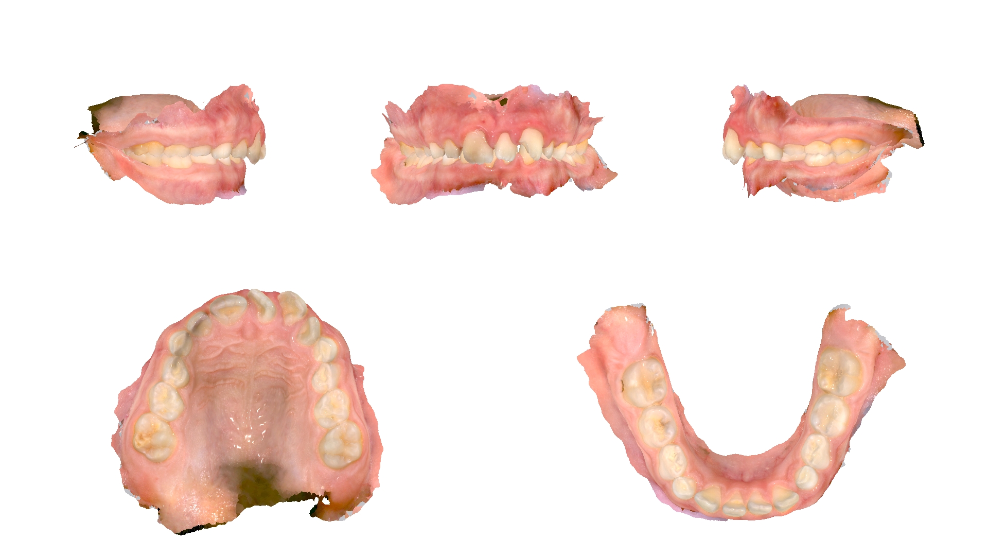 Five-view dental clinical photography showing teeth and gums